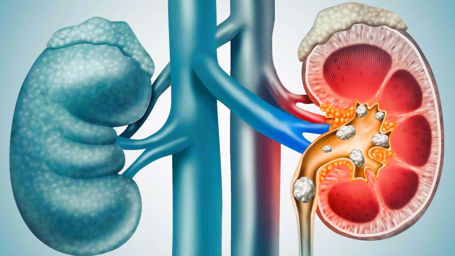 কিডনির পাথর প্রতিরোধের ১০টি উপায়