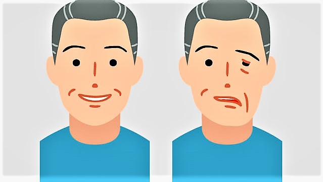 ফেসিয়াল প্যারালাইসিস বা মুখ বেঁকে যাওয়া রোগের চিকিৎসা করবেন যেভাবে